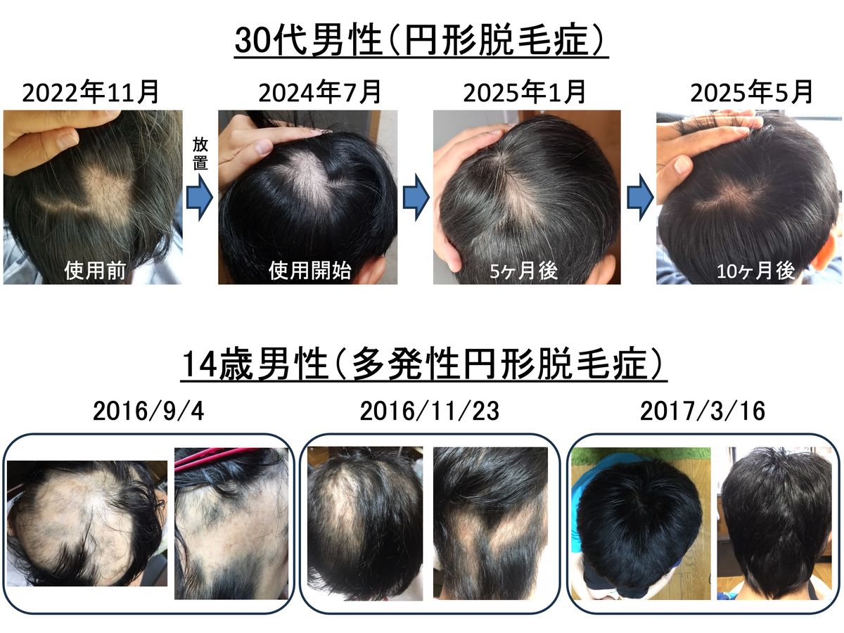 円形脱毛症の経過